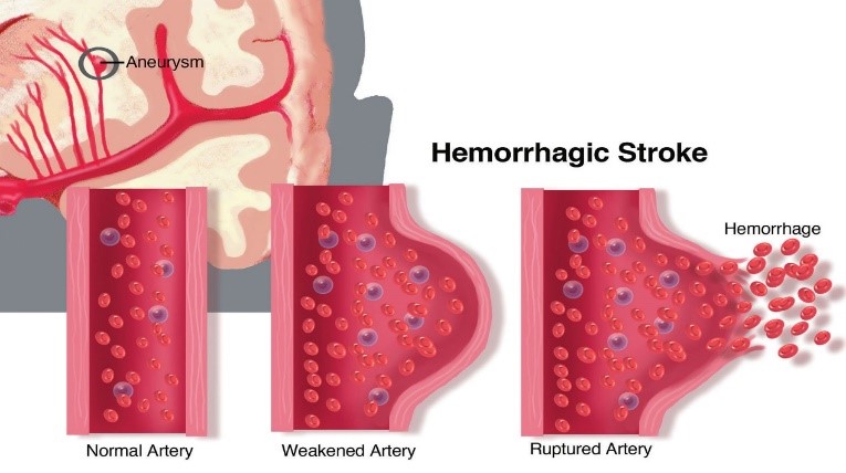 Hemorrhagic stroke