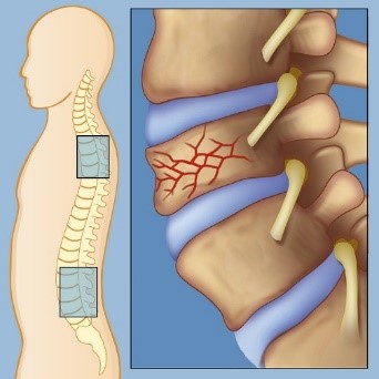 Vertebral compression fracture