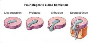 Four stages of the formation of an intervertebral hernia