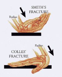 Collis and Smith fracture