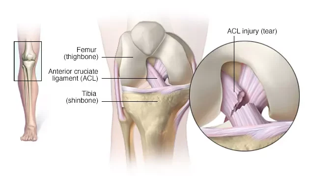 Anterior cruciate ligament (ACL) injury. The unlucky triad