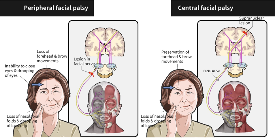 central and peripheral paresis (paralysis) of the facial nerve