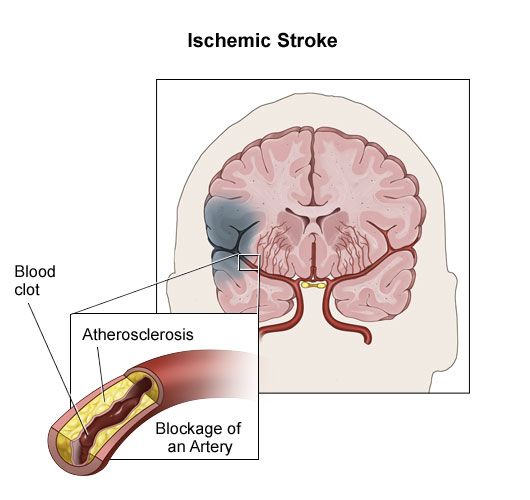 Ischemic stroke