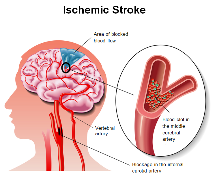 ischemic stroke 