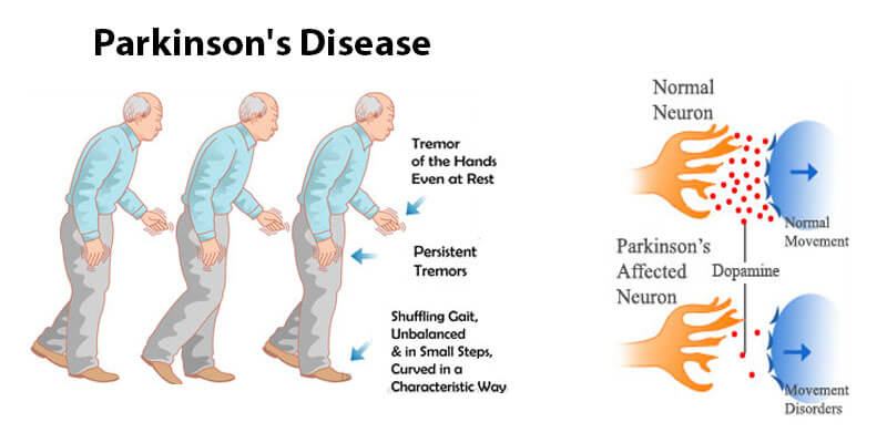 Parkinson's Disease Risk factors