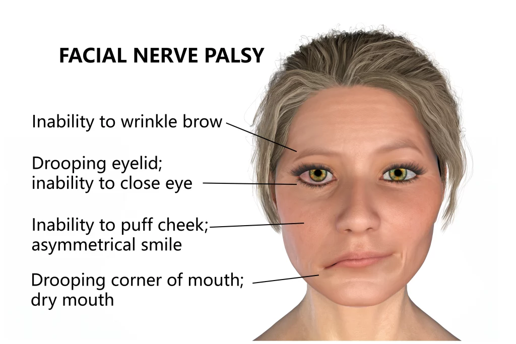 Symptoms noticeable to patients with facial nerve palsy