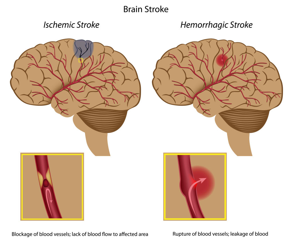 Causes and types of stroke