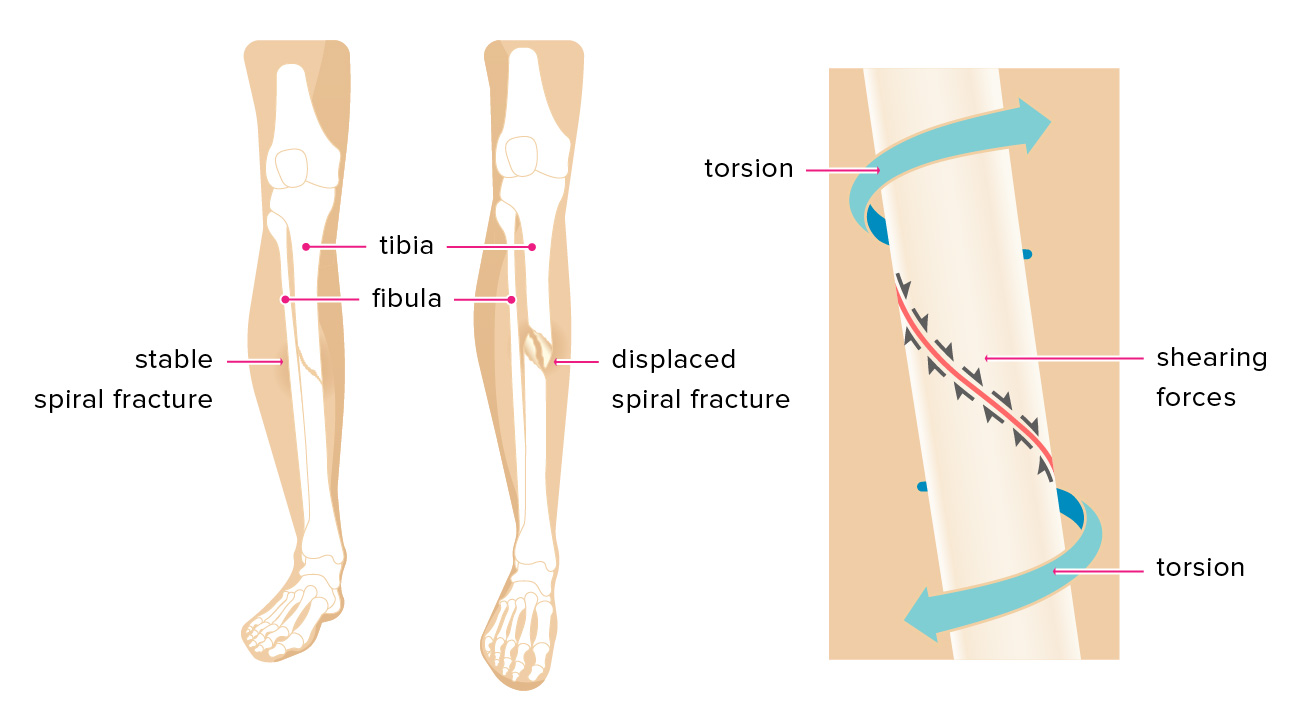 spiral fracture, Tibial Fractures