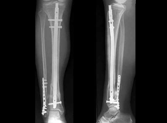 Metal Osteosynthesis