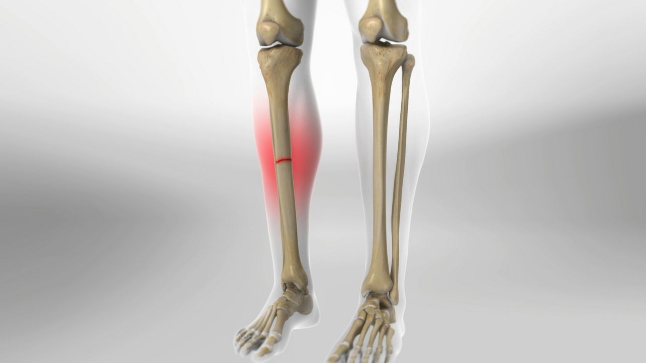 the Tibia and Its Functions. Tibial Fractures