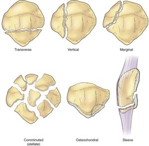 Classification of Patellar Fractures