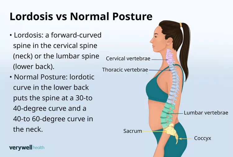 lordosis